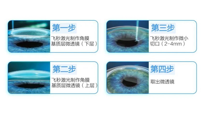 全飞秒手术原理示意图