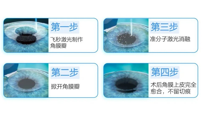 半飞秒手术原理示意图