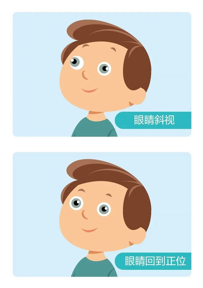 斜视类型示意图