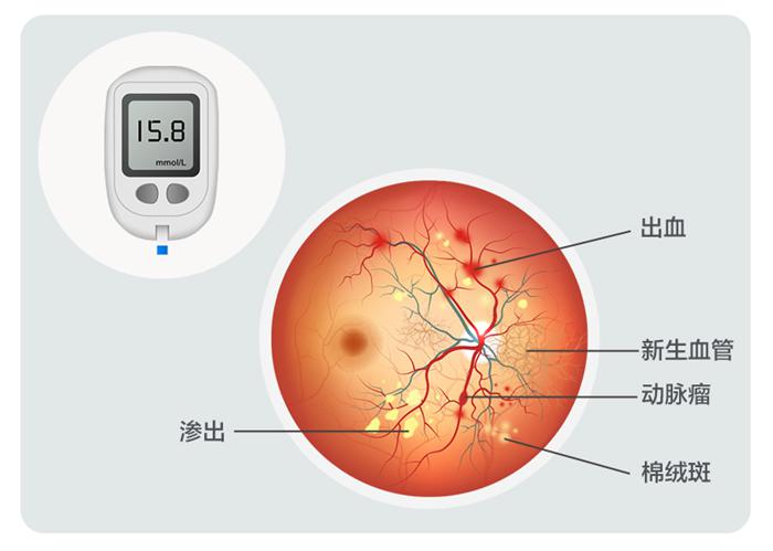 糖尿病眼病示意图