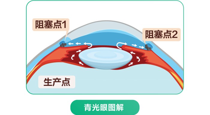 青光眼相关图片