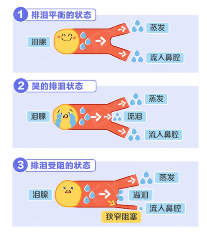 泪道疾病相关图片