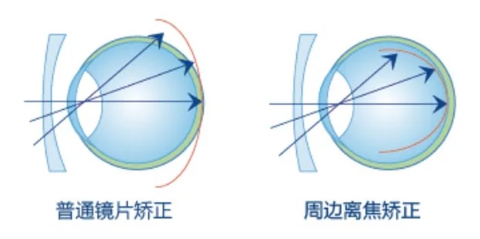 多点离焦眼镜相关图片2