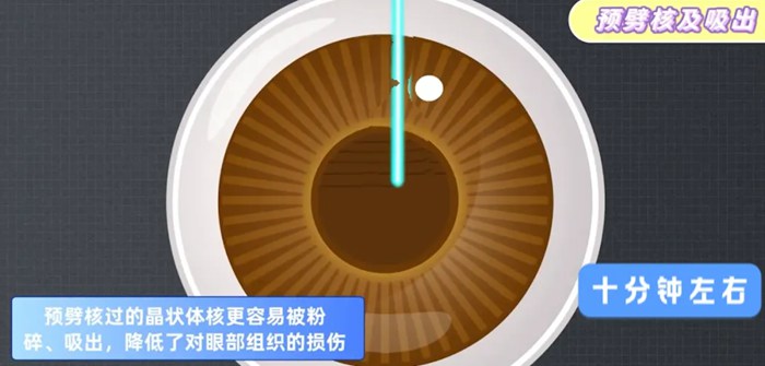 白内障相关图片5