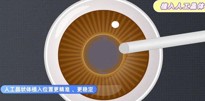 白内障相关图片6